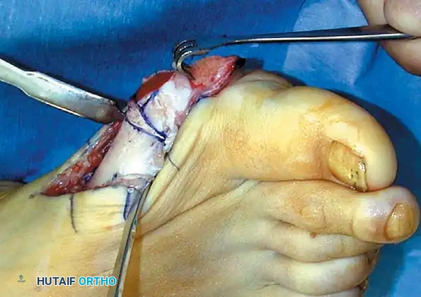 Disorders of the Hallux Surgical Diagram