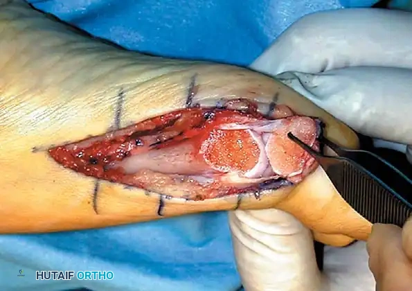 Disorders of the Hallux Surgical Diagram
