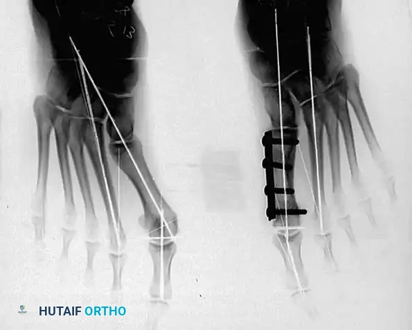 Disorders of the Hallux Surgical Diagram