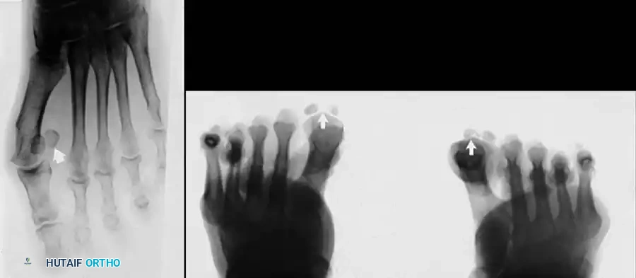 Disorders of the Hallux Surgical Diagram