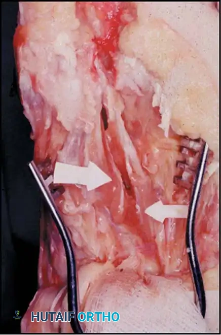 Disorders of the Hallux Surgical Diagram