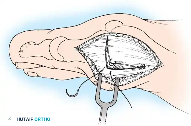 Disorders of the Hallux Surgical Diagram
