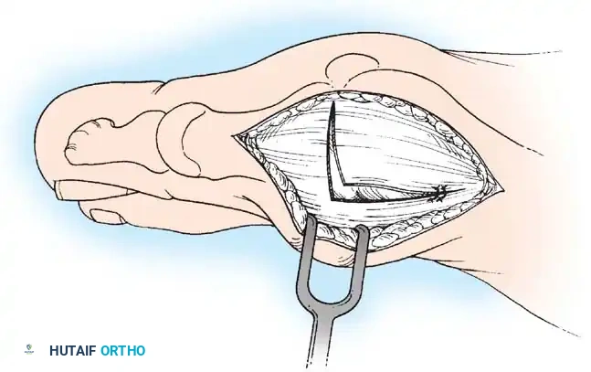 Disorders of the Hallux Surgical Diagram