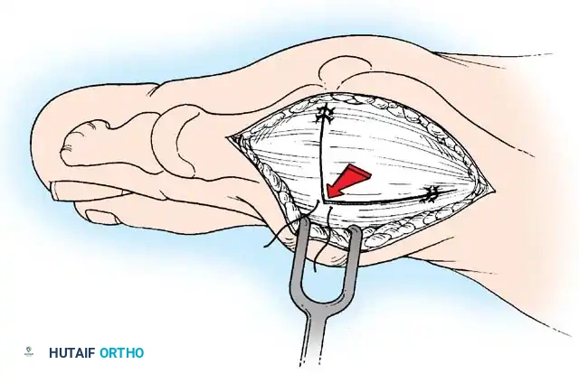 Disorders of the Hallux Surgical Diagram