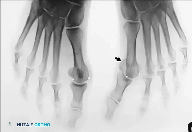 Disorders of the Hallux Surgical Diagram