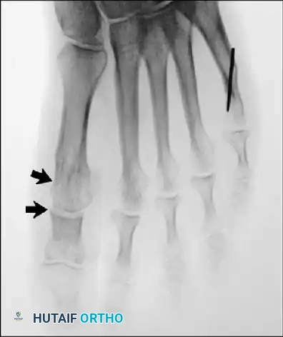 Disorders of the Hallux Surgical Diagram