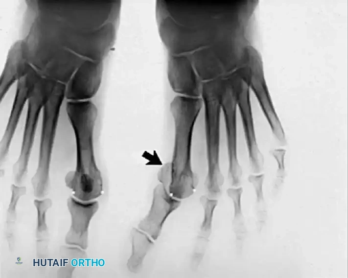 Disorders of the Hallux Surgical Diagram