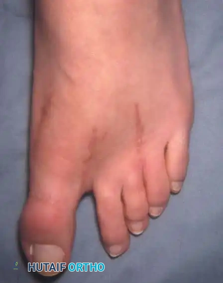 Fig. 78-72 A, Fixed hallux varus after McBride bunionectomy. B, Hallux varus after McBride bunionectomy with fi bular sesamoid excision. Removing fi bular sesamoid removes valgusproducing moments of adductor hallucis and fl exor hallucis brevis (lateral head) muscles.