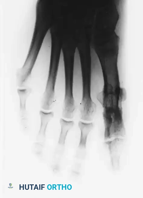 Fig. 78-75 A and B, Hyperextension of metatarsophalangeal joint and hyperfl exion of interphalangeal joint, in addition to varus and rotation of hallux. C and D, Dynamic (supple) deformity treated by arthrodesis of fi rst metatarsophalangeal joint and plantar release of interphalangeal joint.