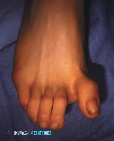 Fig. 78-75 A and B, Hyperextension of metatarsophalangeal joint and hyperfl exion of interphalangeal joint, in addition to varus and rotation of hallux. C and D, Dynamic (supple) deformity treated by arthrodesis of fi rst metatarsophalangeal joint and plantar release of interphalangeal joint.