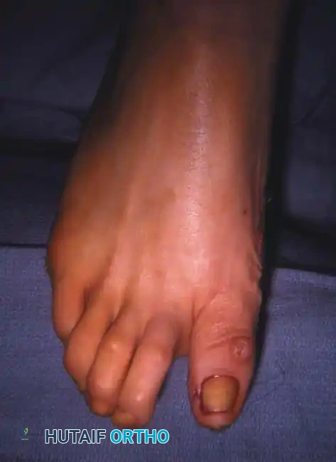 Fig. 78-75 A and B, Hyperextension of metatarsophalangeal joint and hyperfl exion of interphalangeal joint, in addition to varus and rotation of hallux. C and D, Dynamic (supple) deformity treated by arthrodesis of fi rst metatarsophalangeal joint and plantar release of interphalangeal joint.