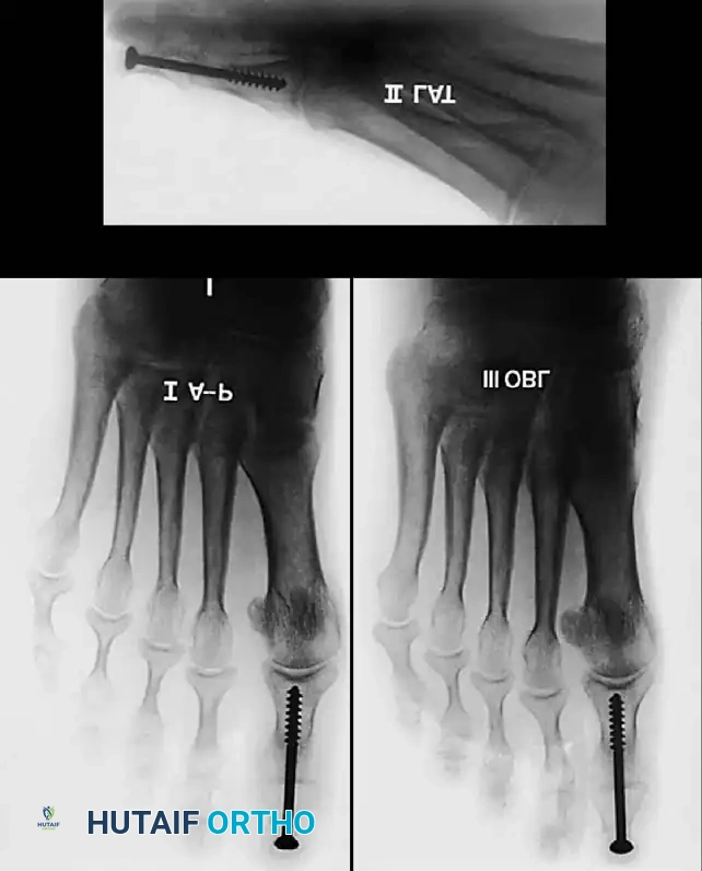 Disorders of the Hallux Surgical Diagram