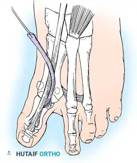 Disorders of the Hallux Surgical Diagram