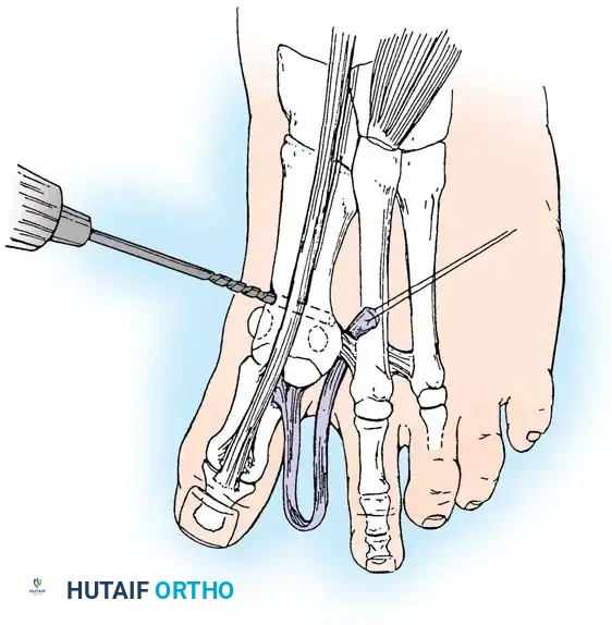 Disorders of the Hallux Surgical Diagram
