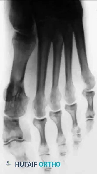 Disorders of the Hallux Surgical Diagram