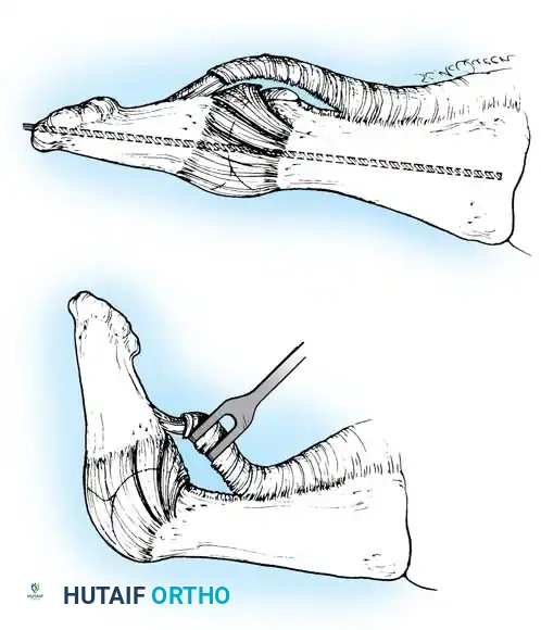 Disorders of the Hallux Surgical Diagram