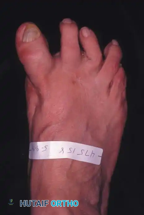 Fig. 78-82 Dorsomedial subluxation of hallux after fi bular sesamoidectomy, medial capsular imbrication, and displacement of tibial sesamoid medially.