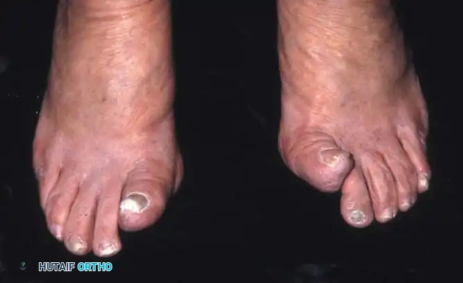 Fig. 78-84 Hallux extensus on right foot and hallux extensus and recurrent valgus on left foot. These complications should be preventable when suggested techniques are used. (From Richardson EG, Graves SC: Keller bunionectomy. In Myerson M, ed: Current therapy in foot and ankle surgery , St Louis, 1993, Mosby.)