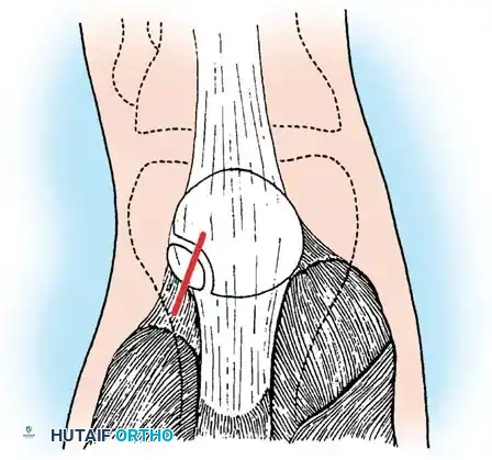 DISORDERS OF THE PATELLA Surgical Diagram