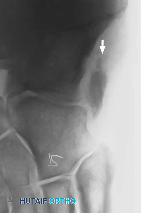 Fig. 85-30 A, Sixty-one–yearold man with rupture of peroneus longus tendon and varus of right foot. Peroneus brevis tendon had longitudinal split tear but was intact. B, Note hypertrophic os peroneum and its proximal migration after rupture. He also had lateral ankle instability compared with opposite side.