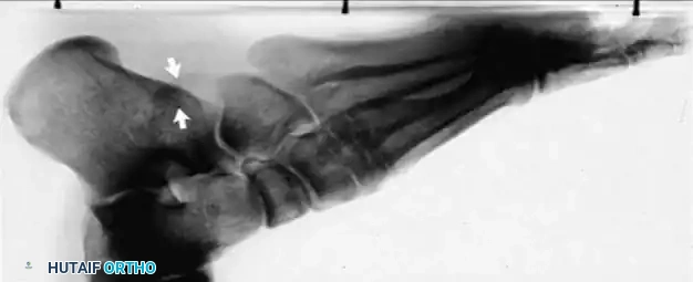 DISORDERS OF THE PERONEAL TENDONS Surgical Diagram