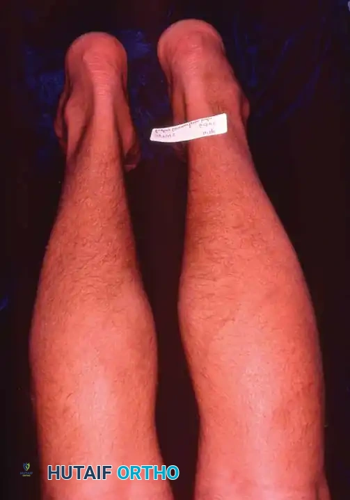 Disorders of the Peroneal Tendons: Comprehensive Diagnosis and Surgical Management