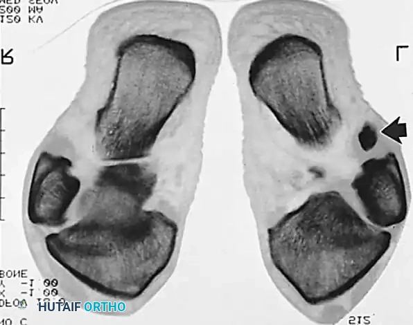 DISORDERS OF THE PERONEAL TENDONS Surgical Diagram