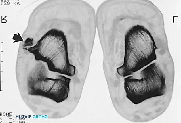 DISORDERS OF THE PERONEAL TENDONS Surgical Diagram