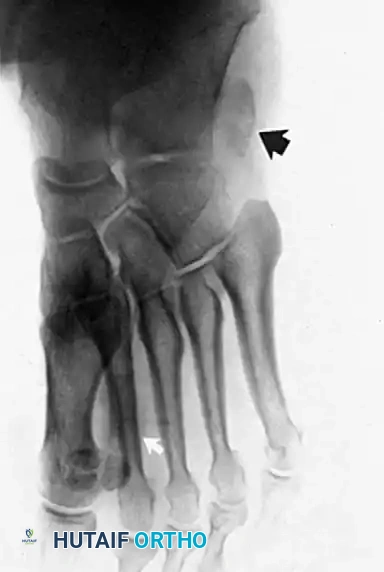DISORDERS OF THE PERONEAL TENDONS Surgical Diagram