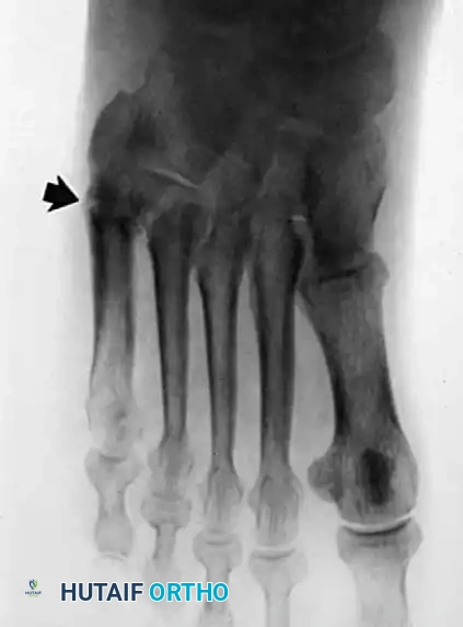 DISORDERS OF THE PERONEAL TENDONS Surgical Diagram