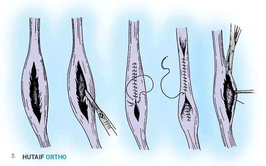 DISORDERS OF THE PERONEAL TENDONS Surgical Diagram