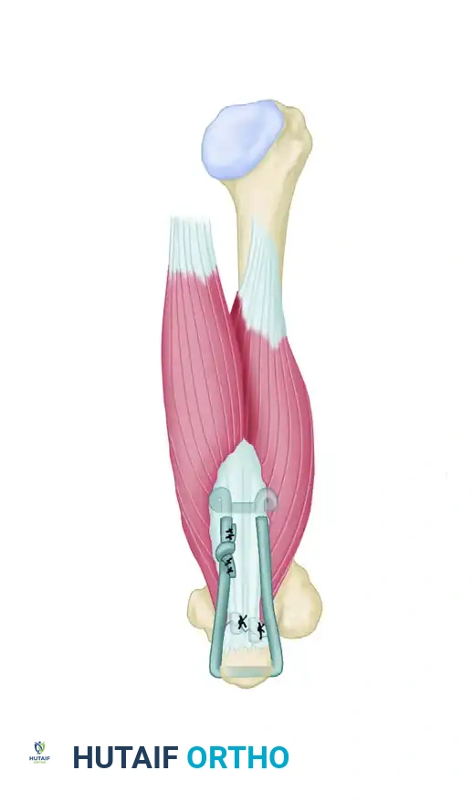 DISPLACEMENT OF TENDONS Surgical Diagram