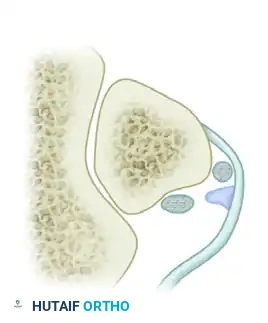 DISPLACEMENT OF TENDONS Surgical Diagram