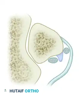 DISPLACEMENT OF TENDONS Surgical Diagram