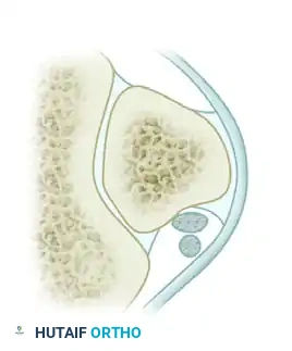 DISPLACEMENT OF TENDONS Surgical Diagram