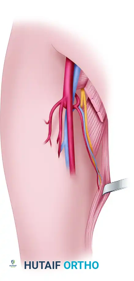 Gracilis and Tensor Fasciae Latae Muscle Flaps: A Master Surgical Guide