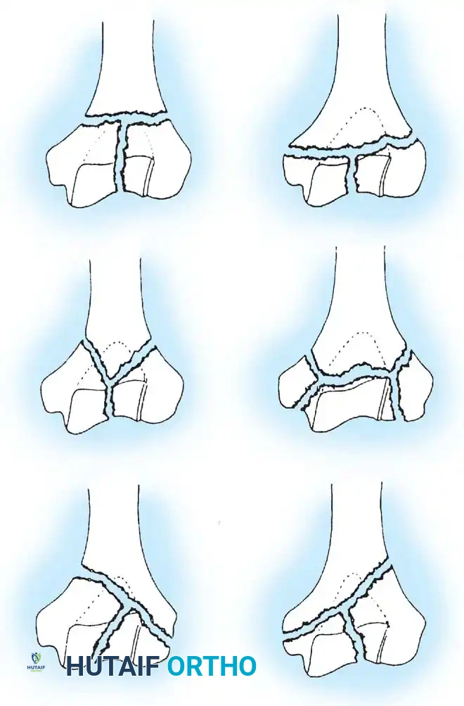 Masterclass in Distal Humeral Fractures: Surgical Techniques, Biomechanics, and Outcomes