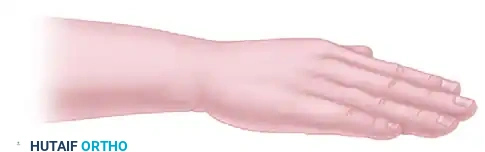 Tenodesis of the Extensor Carpi Ulnaris and Transfer of the Pronator Quadratus for Distal Ulna Instability