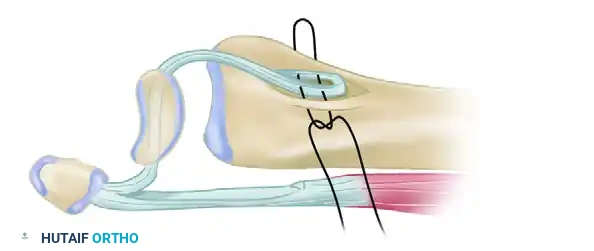 DORSAL CAPSULODESIS Surgical Diagram