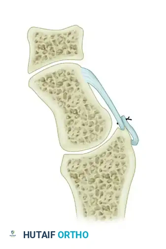 DORSAL CAPSULODESIS Surgical Diagram
