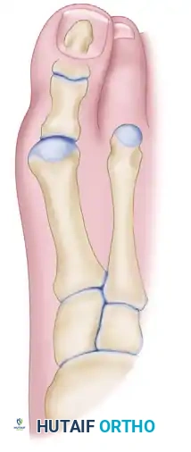 DOUBLE FIRST METATARSAL OSTEOTOMIES Surgical Diagram
