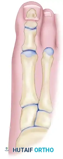 DOUBLE FIRST METATARSAL OSTEOTOMIES Surgical Diagram