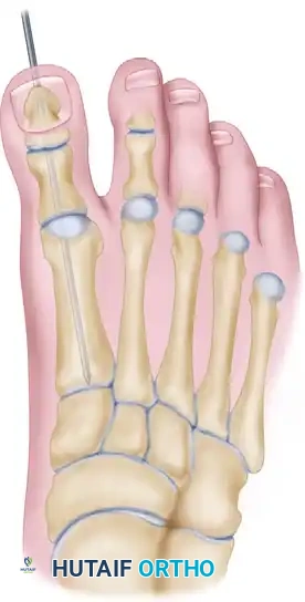 DOUBLE FIRST METATARSAL OSTEOTOMIES Surgical Diagram