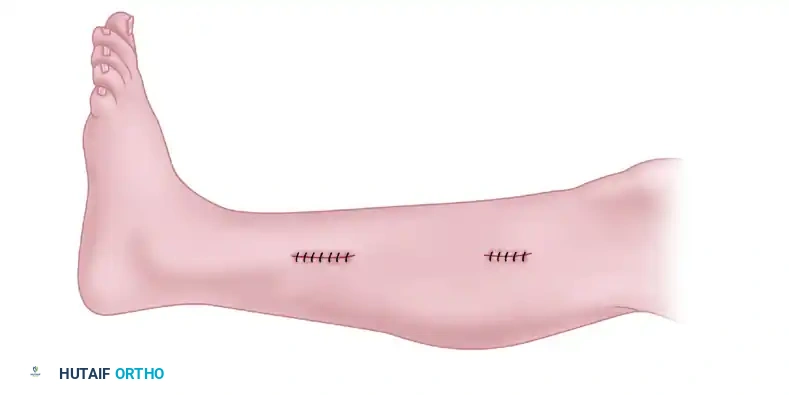 DOUBLE MINI-INCISION FASCIOTOMY FOR CHRONIC ANTERIOR COMPARTMENT SYNDROME Surgical Diagram