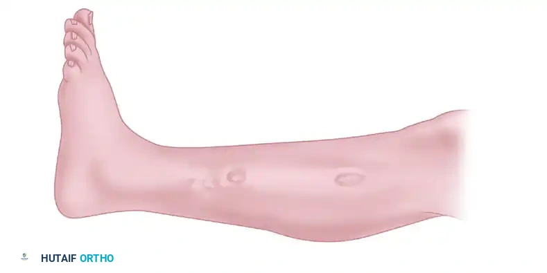 DOUBLE MINI-INCISION FASCIOTOMY FOR CHRONIC ANTERIOR COMPARTMENT SYNDROME Surgical Diagram