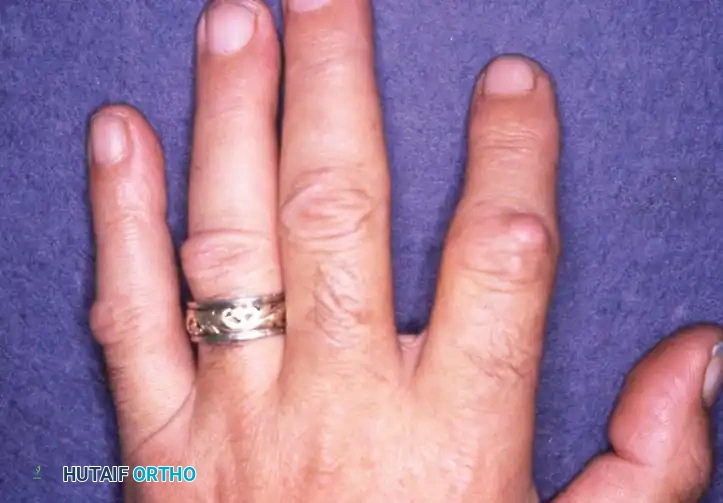 Dupuytren Contracture: Comprehensive Pathoanatomy and Surgical Management