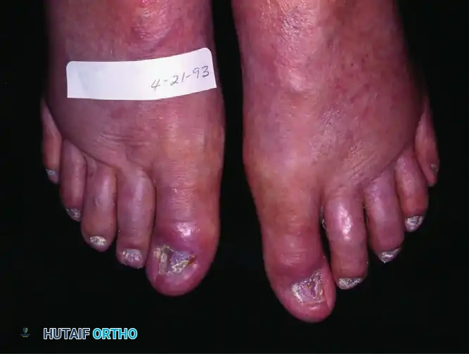 DYSTROPHIC NAILS (ONYCHOGRYPOSIS, ONYCHOMYCOSIS) Surgical Diagram