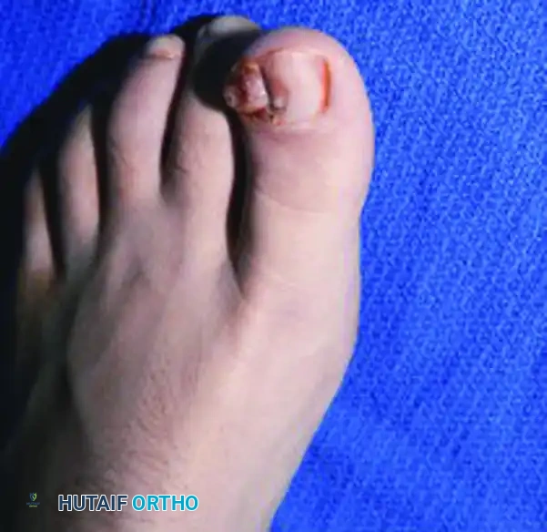 DYSTROPHIC NAILS (ONYCHOGRYPOSIS, ONYCHOMYCOSIS) Surgical Diagram