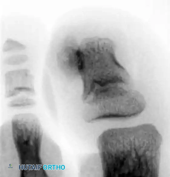 DYSTROPHIC NAILS (ONYCHOGRYPOSIS, ONYCHOMYCOSIS) Surgical Diagram