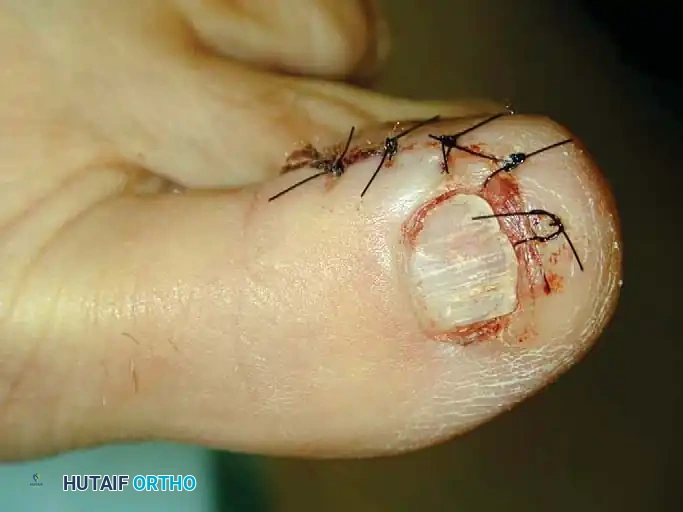 رسم يوضح استئصال الورم الكبي بعد كشفه